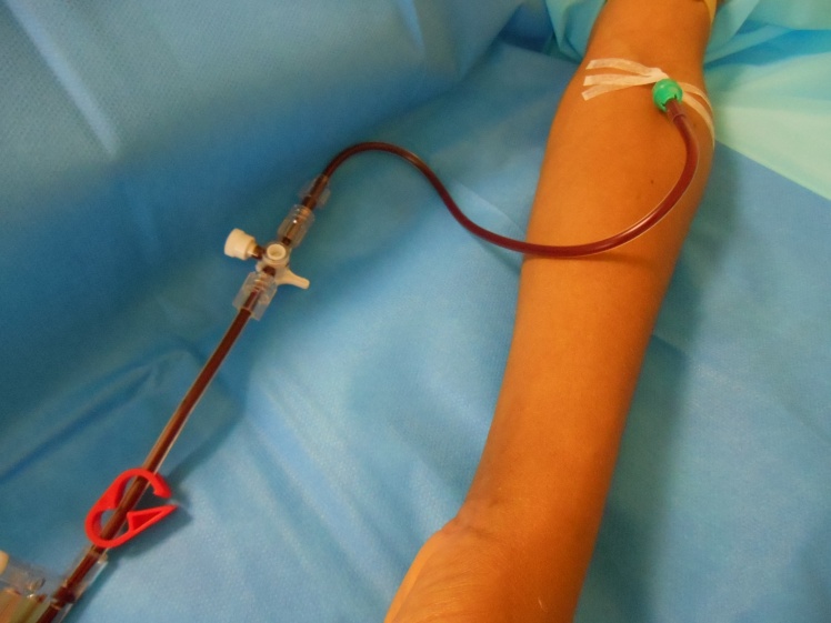 catheter-de-saignée-echange-transfusionnel.jpg